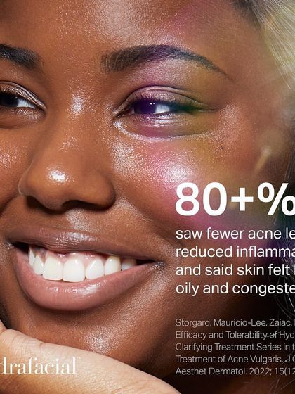 Over 80% of participants in a study saw fewer acne lesions, reduced inflammation, and said their skin felt less oily and congested after Hydrafacial treatments.