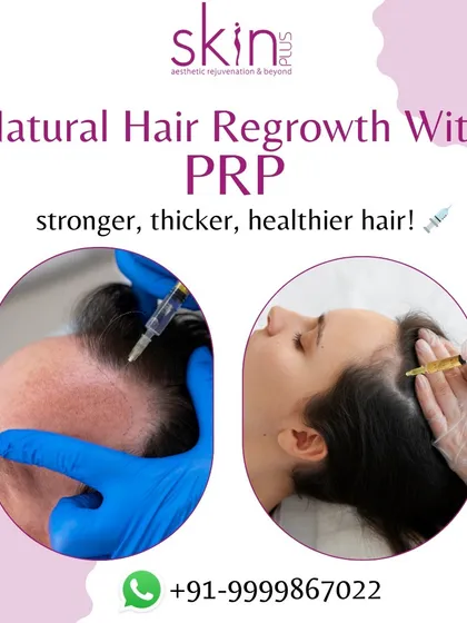 This image shows the application of PRP for natural hair regrowth. I perform this procedure for both male and female pattern hair loss, injecting platelet-rich plasma to nourish the scalp and encourage stronger, thicker hair.