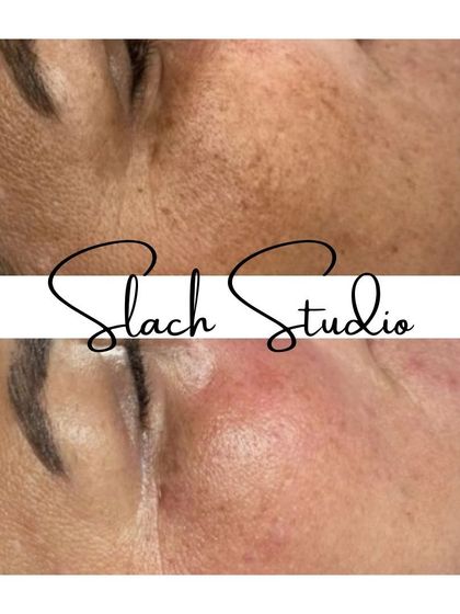 A close-up before-and-after of the Korean Glass Skin treatment, showing a dramatic reduction in fine lines and pigmentation around the eye and cheek area.