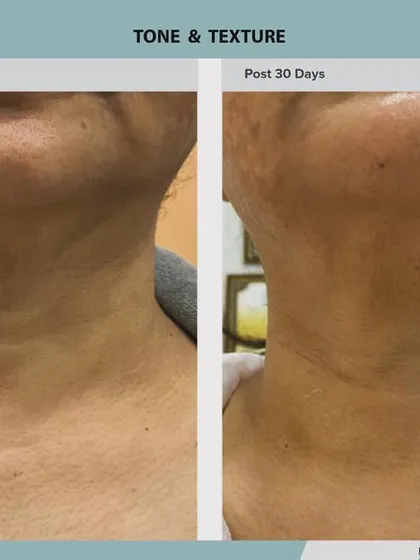 Here, the treatment targeted laxity and texture in the neck and under the chin. The result is a visibly tighter and smoother neckline.