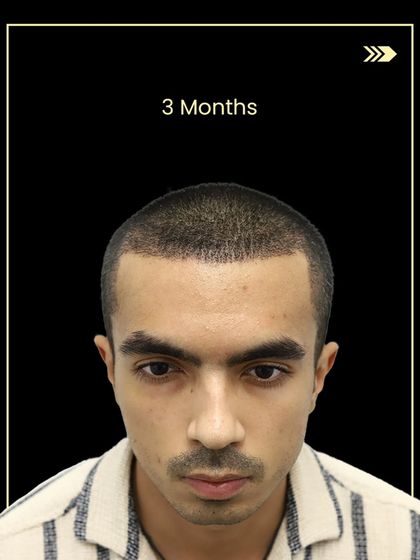 Gaurav's progress at 3 months. Even at this early stage, you can see the new hair starting to create a fuller look.