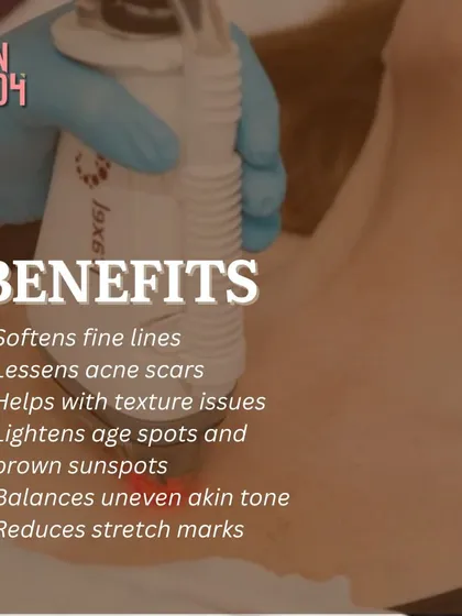 See the incredible benefits of our advanced peel treatments. They soften fine lines, lessen acne scars, improve texture, lighten age spots, and even out skin tone for a complete skin refresh.