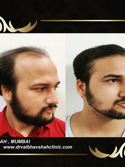 A three-quarter view demonstrating the density and the natural look of the transplant.