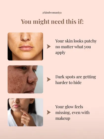 If your skin looks patchy, your glow feels missing even with makeup, or dark spots are getting harder to hide, it might be a sign of underlying pigmentation. These are common concerns that I address with targeted, gentle treatments designed to restore your skin's natural brightness.