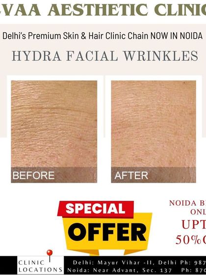 This before-and-after image shows the visible reduction of fine lines and wrinkles achieved with our specialized HydraFacial treatments.