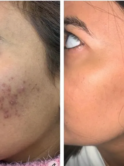 This is another example of the progress that can be achieved with a structured treatment plan. After six sessions of targeted chemical peels, the patient's skin shows a dramatic improvement in clarity and a reduction in active acne lesions.