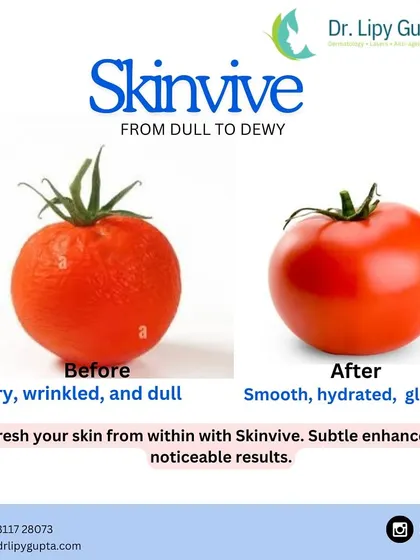 This image perfectly illustrates the effect of Skinvive. It transforms skin from dry and dull to smooth, hydrated, and glowing. Skinvive is an injectable moisturizer that provides subtle enhancement with noticeable, refreshing results from within.