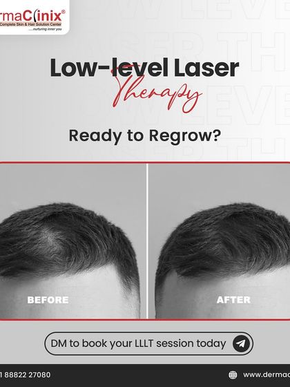 Ready to regrow? This before-and-after image shows the visible improvement in hair density that can be achieved with LLLT sessions.