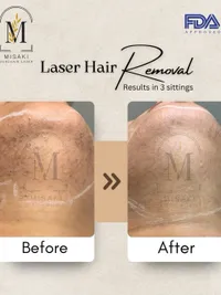 Laser Hair Removal