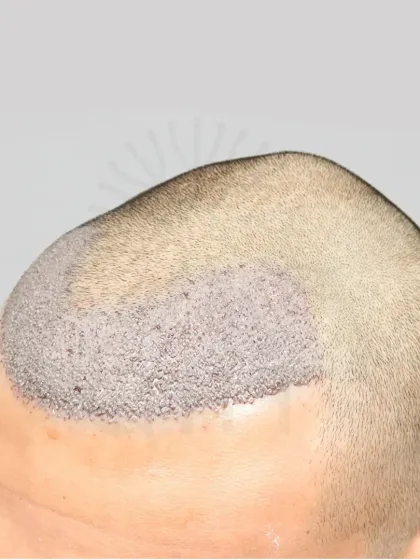 Precision in every graft. A close-up of a 2200 graft placement for a Grade 2 baldness case, focusing on a natural and dense hairline.