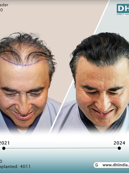 A before and after comparison from 2021 to 2024. This long-term result for a 50-year-old client shows the lasting density and natural look achieved with 4,011 implanted hairs.