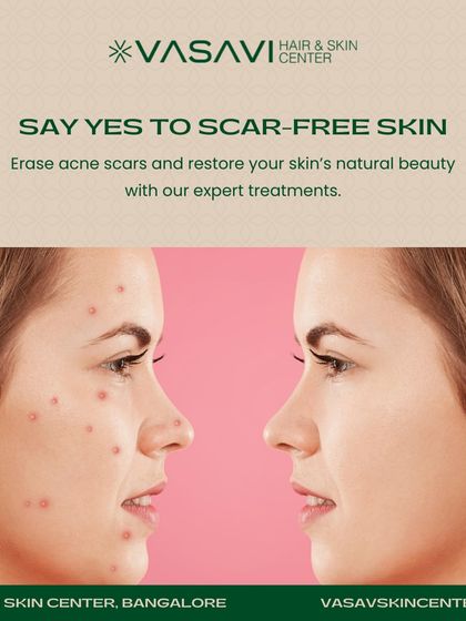 Sree Vasavi - Acne & Scar Treatment Patient Transformations photo 4