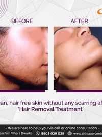Laser Removal Treatments