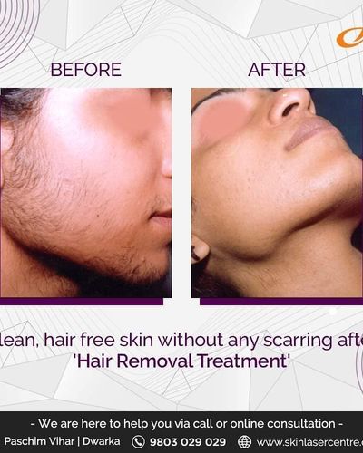 Laser Removal Treatments