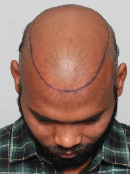 This shows the crucial first step: hairline design. We mark the area precisely to ensure the final result perfectly frames the face.