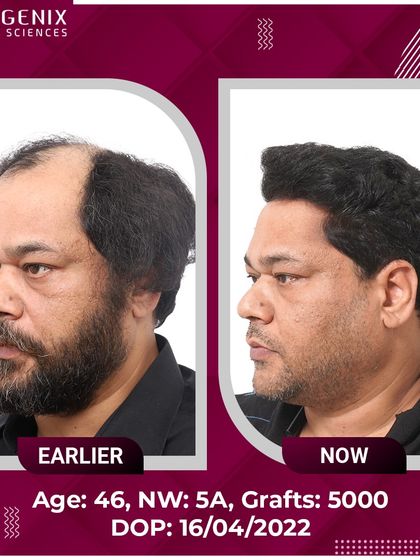A remarkable 5000-graft transformation for a 46-year-old patient with Grade 5A baldness.