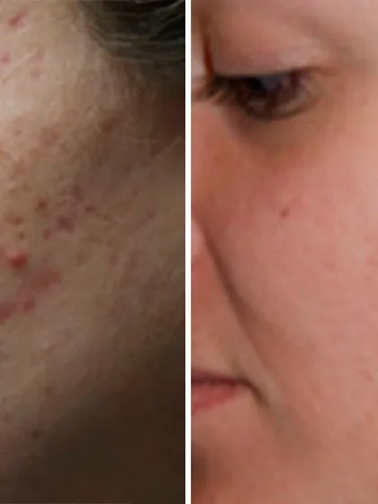 Here is another example of how targeted treatments can effectively manage and reduce the appearance of acne and the red marks left behind, leading to a healthier complexion.