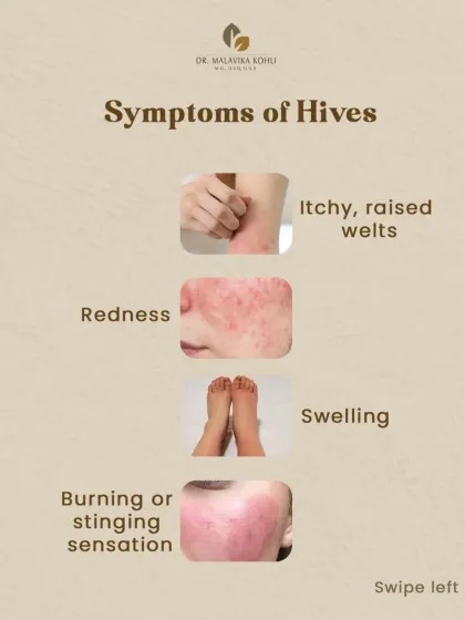 The primary symptoms of hives include itchy, raised welts and surrounding redness. Some individuals may also experience swelling (angioedema) or a burning or stinging sensation in the affected areas.