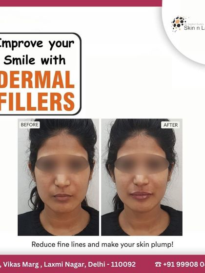 This before-and-after image shows the subtle yet impactful result of using dermal fillers. Notice how the treatment has reduced fine lines and added plumpness to the skin, creating a more youthful and refreshed smile without looking unnatural.