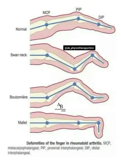 Rheumatoid arthritis can cause specific finger deformities like Swan Neck or Boutonnière. We help manage RA symptoms to preserve hand function and reduce pain.