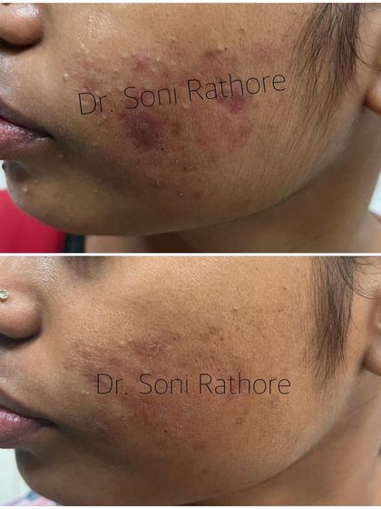 This side profile view highlights the reduction in inflamed acne lesions along the jawline. This area is often affected by hormonal fluctuations, and a targeted treatment plan is essential.