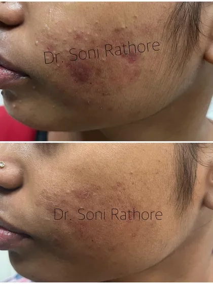 This side profile view highlights the reduction in inflamed acne lesions along the jawline. This area is often affected by hormonal fluctuations, and a targeted treatment plan is essential.