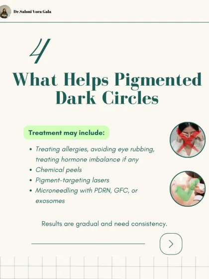 What helps pigmented dark circles? Treatment may include a combination of approaches, from addressing underlying allergies to in-clinic procedures like chemical peels, pigment-targeting lasers, or microneedling with PDRN. Results are gradual and require consistency.