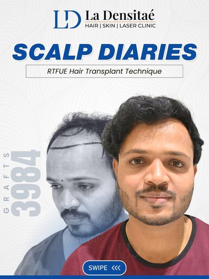 For Mr. Tushar, the plan was to restore density with a technique that ensures long-term results. With 3,984 grafts using the RT-FUE technique, I focused on controlled placement and scalp health to create a result that looks like his own hair.