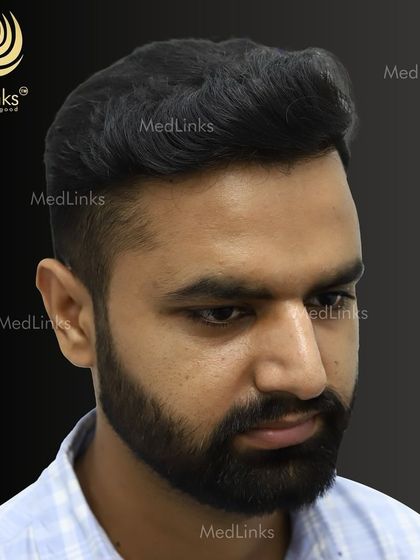 The final result from the side, showing a natural and dense hairline.