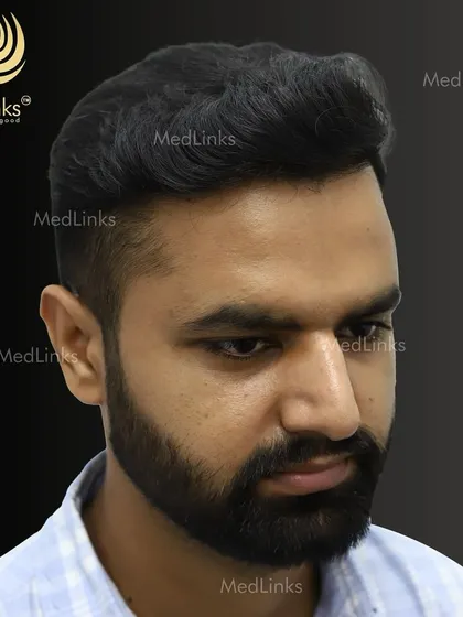 The final result from the side, showing a natural and dense hairline.