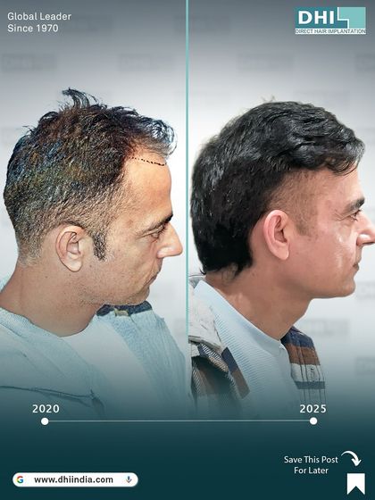 A side-profile view of a client's transformation from 2020 to 2025. This long-term result shows the permanence and natural look of the 4,139 hairs implanted using our DHI technique.