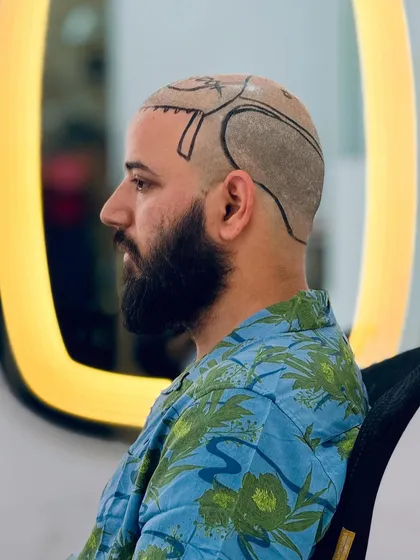 A patient sits in our modern clinic, with his hairline marked for the DHI procedure. The bright, clean environment is designed to make you feel comfortable.
