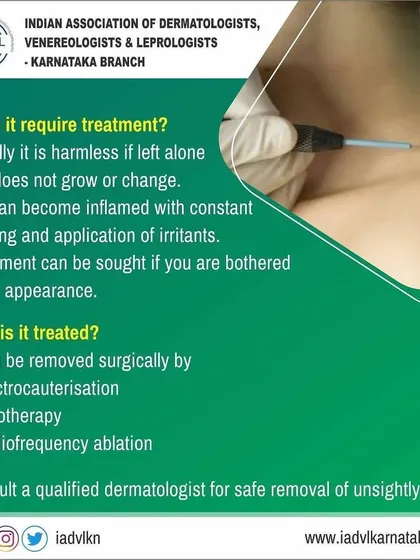An informational post detailing the professional treatment options for skin tags. We explain that while often harmless, removal can be done via methods like electrocauterisation or radiofrequency ablation for cosmetic reasons.