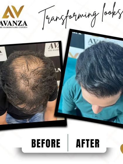 From thin to thick. This before and after comparison clearly shows the remarkable increase in hair volume and coverage, leading to a complete transformation.