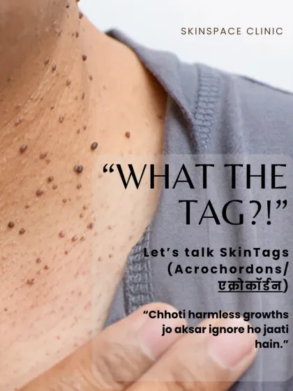 Skin tags, or acrochordons, are very common and harmless, but they can be bothersome when they catch on clothing or jewelry. I provide quick, safe, and virtually painless removal procedures in the clinic for clear, smooth skin.