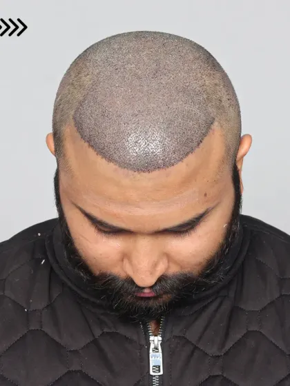 The post-surgery look of a 5500 graft procedure, showing the newly created hairline and dense packing.
