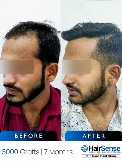 The side profile of this 7-month result highlights the sharp, clean hairline and temple restoration that frames the face perfectly.