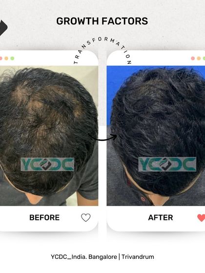This before and after shows the power of non-surgical treatments. Using growth factors, I was able to significantly boost this patient's hair growth and volume, resulting in much better scalp coverage.