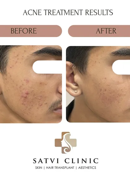This result shows a visible improvement in teenage acne. My approach focuses on controlling inflammation and preventing future breakouts with a customized, easy-to-follow routine, helping to avoid the long-term issue of scarring.