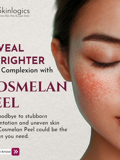 This graphic introduces the Cosmelan Peel as a solution for stubborn pigmentation and uneven skin tone, inviting you to learn more about how it can reveal a brighter complexion.