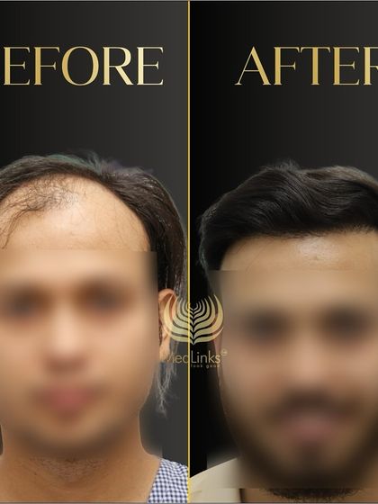 This before and after, with the patient's face blurred, shows a significant improvement in hair density and hairline design.
