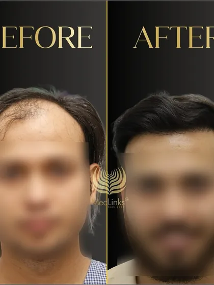 This before and after, with the patient's face blurred, shows a significant improvement in hair density and hairline design.