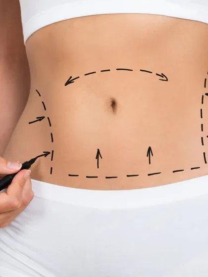 Planning is key to a successful tummy tuck. These surgical markings outline the precise areas for incision and tissue removal, ensuring a result that is both beautiful and natural.