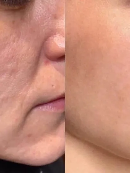 This transformation highlights the power of precision CO2 laser resurfacing. By targeting damaged skin layers, I was able to reduce the appearance of atrophic acne scars and improve overall skin texture.