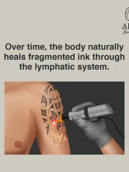 After the laser breaks down the ink, your body’s lymphatic system naturally begins to heal the area and flush out the fragmented ink particles over time.