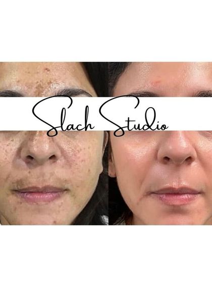 A close-up look at how the Korean Glass Skin treatment tackles melasma and uneven skin texture, resulting in a smoother, brighter appearance.