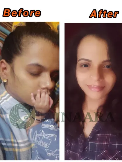 Postpartum hair fall can be distressing, but you don't have to go through it alone. This is a real before and after from one of my dear clients, showing how my products helped her regain hair density and confidence after childbirth.