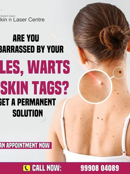 Are you embarrassed by moles, warts, or skin tags? This post offers a permanent solution through our advanced laser treatments.