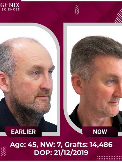 An incredible transformation of a 45-year-old international patient with Grade 7 baldness, who received 14,486 grafts for a full head of hair.
