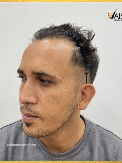 Another angle before the procedure, providing a comprehensive view of the areas we planned to treat.